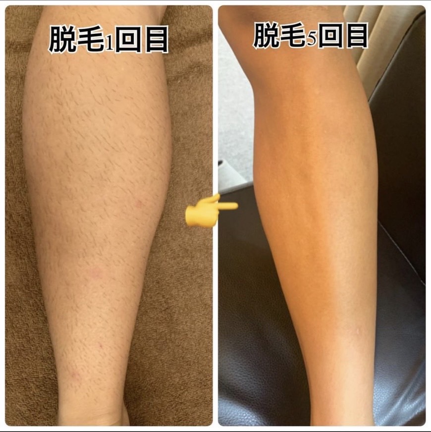 セルフ脱毛 効果 脱毛1回目と5回目の比較